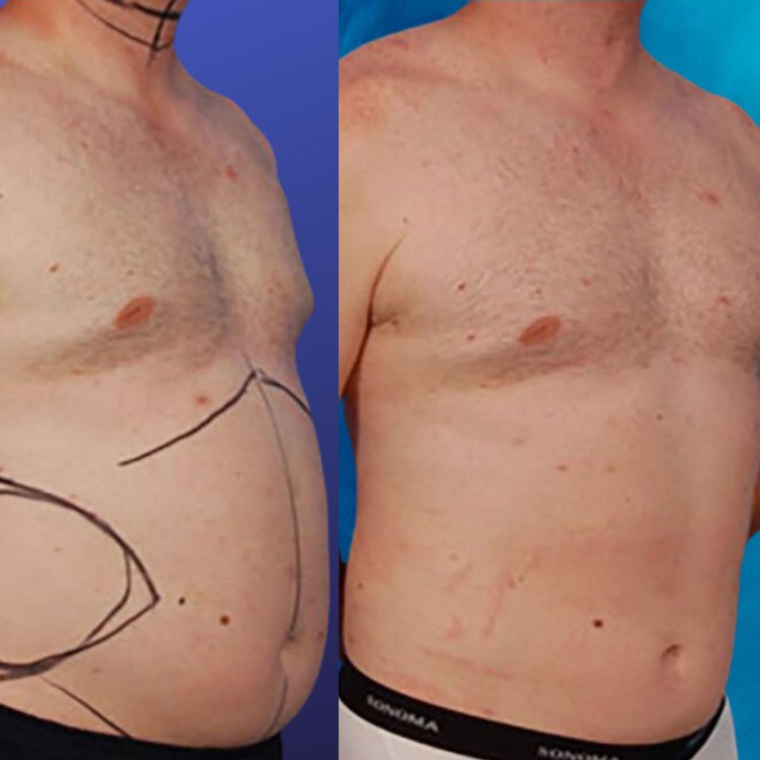 Liposuction NYC: Excellent Choice For Removing Belly Fat