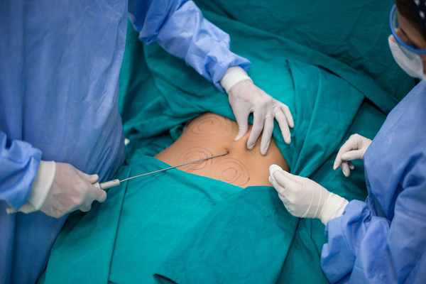 How much does liposuction cost in New York? The Lipo Group